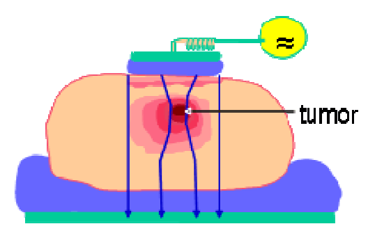 De tumor 'trekt' de elektromagnetische signalen aan, daarom is oncothermie zo effectief